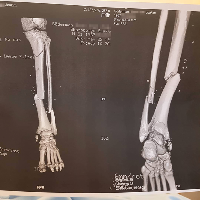Två av totalt 16 frakturer vill inte läka. Men enligt Försäkringskassan kan Joakim Söderman ändå jobba.